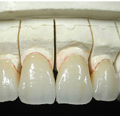 Aparelhos dentrios de correco